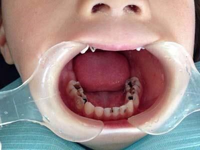 带2岁娃补牙的惨痛经历提醒你:保护宝宝牙齿,