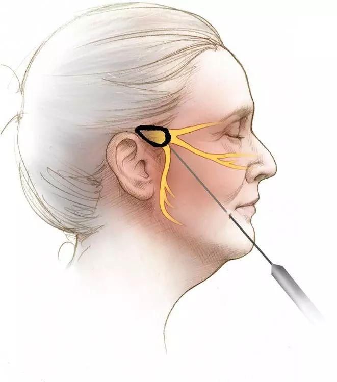 宁波女子遭遇天下第一痛,像被电击,一痛就是