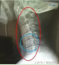 脖子痛?纳尼!我是睡了一个假的乳胶枕吗?