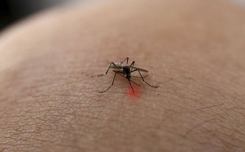 小腿被蚊子叮溃烂 竟是下肢静脉曲张