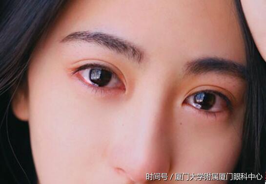 隐形眼镜引发角膜炎,戴隐形的你该怎么办?