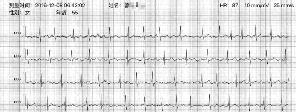 案例分享|房颤术后又复发?单导联院外心电记录仪提供解决方案