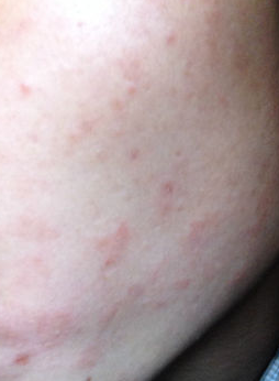 皮肤过敏发病原因有哪些呢?