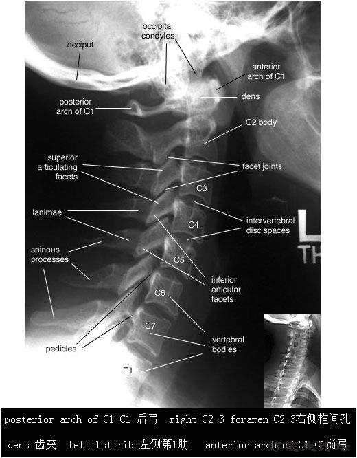 颈椎病到底需要拍X光片,CT还是核磁?
