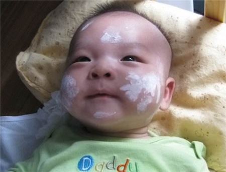 炉甘石洗剂能治湿疹吗