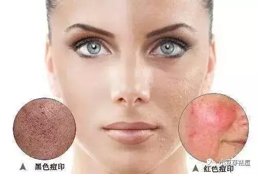 脸上红色痘印发炎怎么办?小豆芽老师教你去除