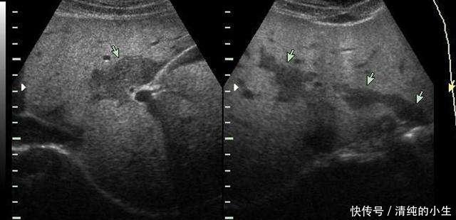 脂肪肝的天敌,每天开水里泡一点,脂肪肝好了