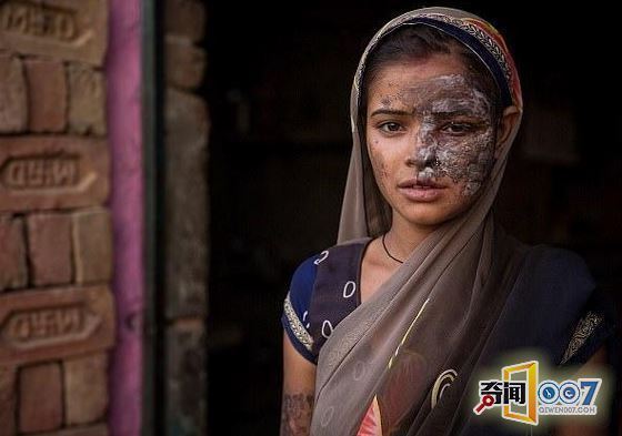 20岁少妇惨遭亲生父亲泼硫酸毁容 只因她做了这件事 20岁少妇惨遭亲生父亲泼硫酸毁容 只因她做了这件事