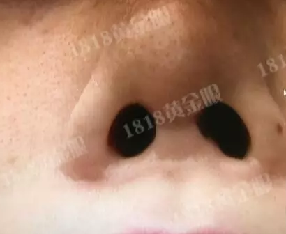 女子做整容全身麻醉 事后方知自己怀孕被迫打胎