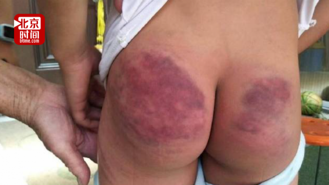 网曝一年级男孩屁股被老师打了100多棍 教体局：涉事教师已停职