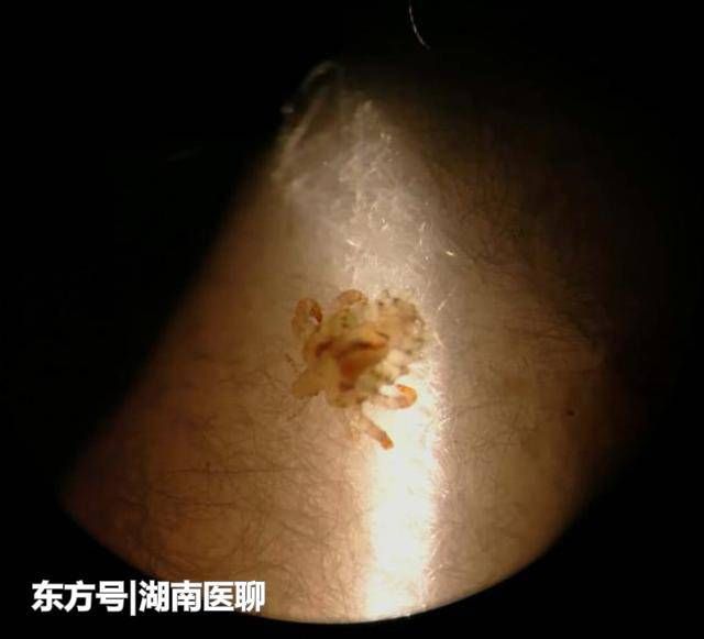 两岁男孩老揉眼睛,亲妈一看吓一跳:睫毛上长虱