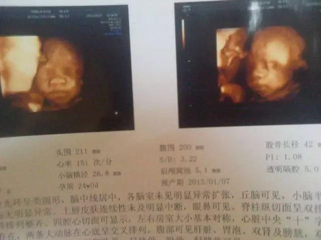 四维彩超真能看胎儿性别,排查畸形?这些秘密医