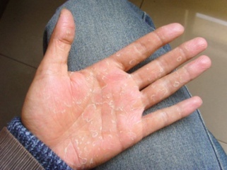 治疗干性湿疹不麻烦 保湿+止痒即可痊愈