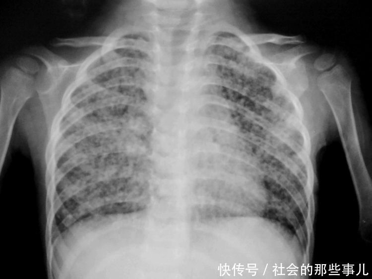 3岁小孩突然不吃饭,医生拍片检查,指着肚子里