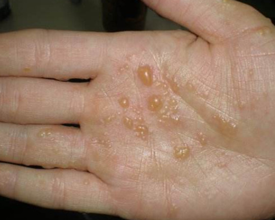 水疱型手癣怎样用药?看完这篇你就学会了