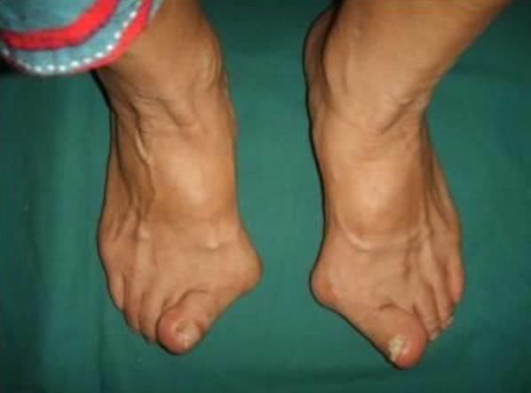 来看看自己是什么脚型!世界上仅少数人才有这