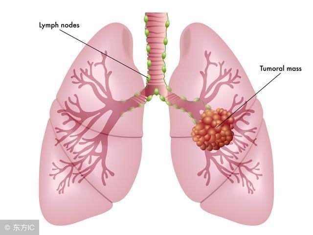 肺里有结节就是肺癌吗?肺癌早期常见症状的具