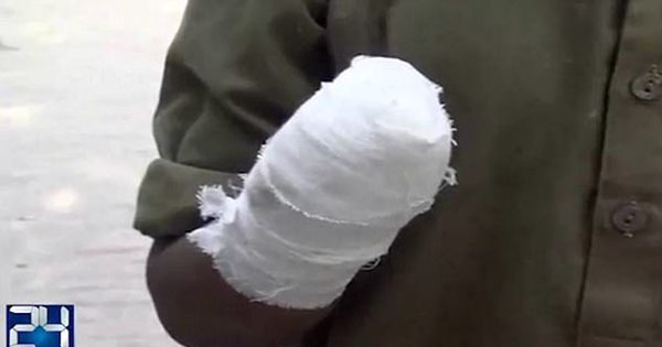 巴基斯坦13岁童工抱怨欠薪竟被雇主砍下一只手