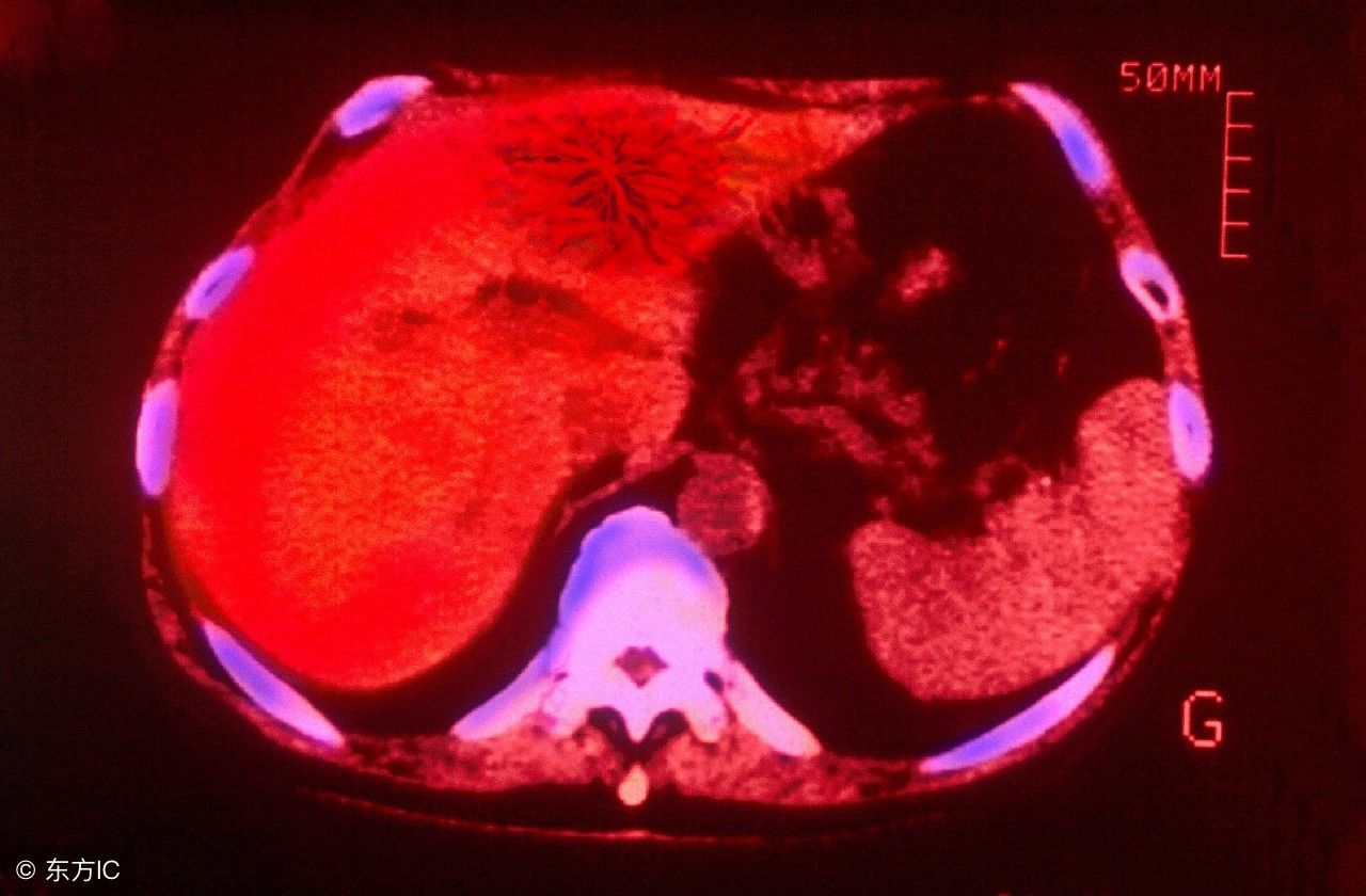 男子左肩疼2个月查出胰腺癌!千万注意,肩背部