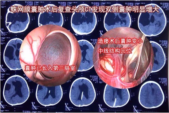 蛛网膜囊肿术后脑积水继发囊肿,软性内镜下造