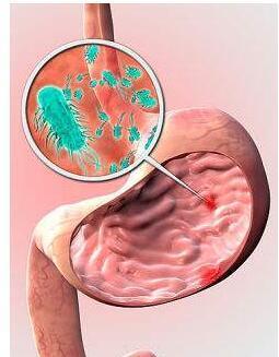 治疗幽门螺杆菌感染新方法,四联药物搭配益生
