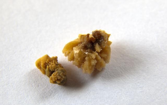 多大的肾结石需要手术?中医1种方法可以排石