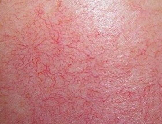 敏感肌或过敏肌?很多人傻傻分不清,这几个鉴别