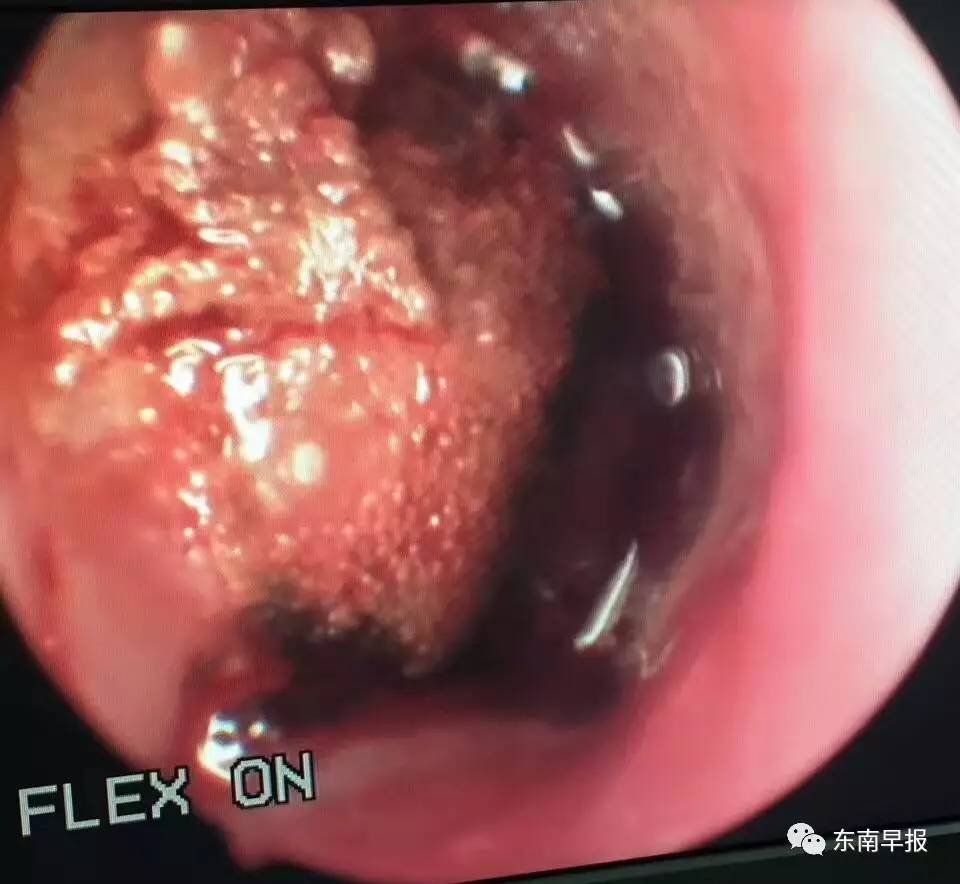 4岁男童把纽扣式电池塞入鼻子 手术时鼻腔已糜烂