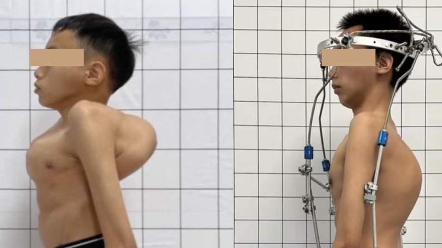 小伙脊柱拧成麻花,背如刀片,“天花板”级手术让他身高增长24厘米 小伙脊柱拧成麻花,背如刀片,“天花板”级手术让他身高增长24厘米