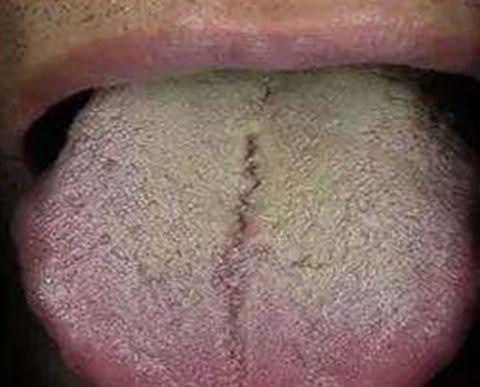 舌头边成锯齿状,竟是湿气太重,1招除湿超快,男