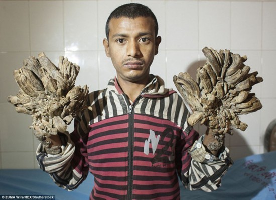 孟加拉国一位“树人”有望被治愈，医生为其长满枝状疣的双手进行了16次手术。 阿布·巴吉安达患有罕见的、俗称“树人病”的遗传性疾病。 为了移除四肢上生长的重达11磅（约5公斤）的枝状疣，他不得不接受16次手术。 医生们现在希望阿布能够成为患此病者中第一个被治愈的人。(图片来源：每日邮报）