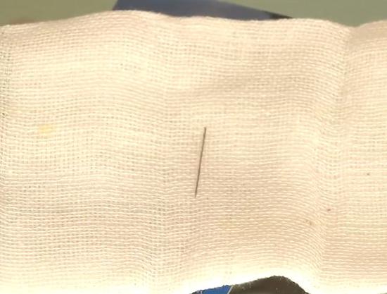 医生通过手术,从张大姐的臀部里取出了一根长达2厘米的细针.