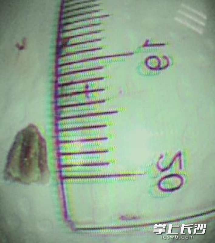 长沙一女子20多年咳嗽不止 元凶竟是肺部有一