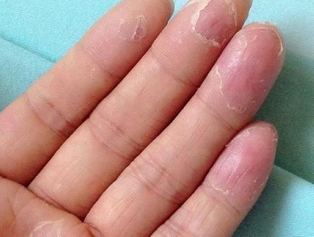 手脱皮是怎么回事?维生素E可以直接抹手吗?这