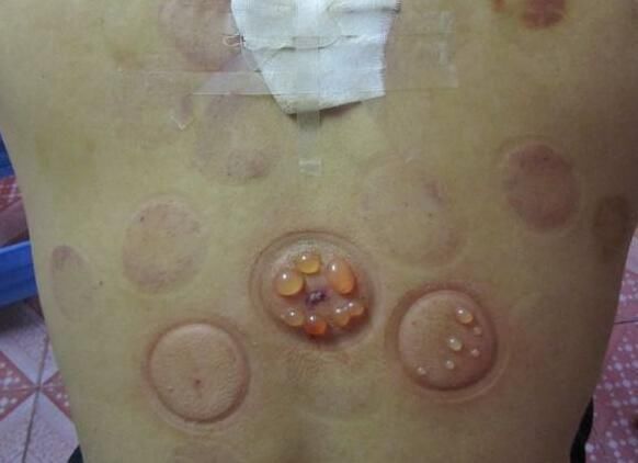 祛湿气别花钱,红枣和它用,3天见効,一辈子告别