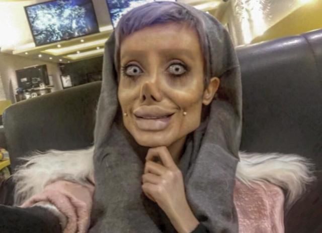 美女为变成"安吉丽娜朱莉"动刀50多次,现在样子惨到爆