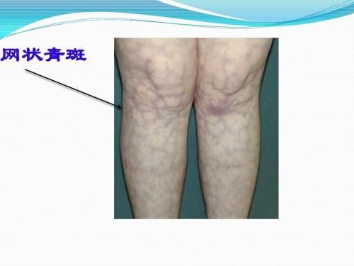 系统性红斑狼疮脑病的临床表现