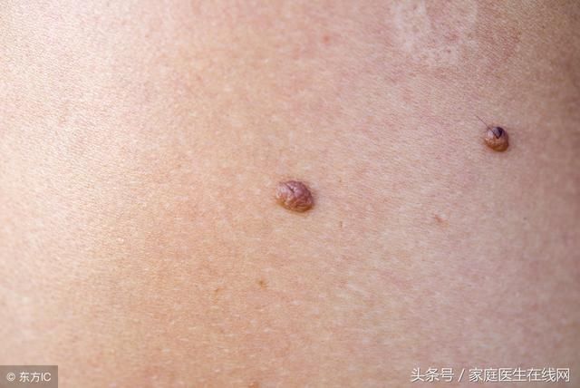 药水点痣好吗?皮肤科医生:祛痣还是要选择这一