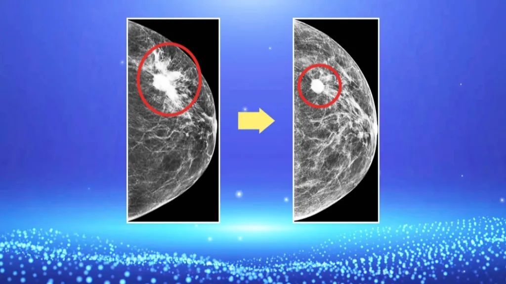 乳腺机是什么【养生堂】今日17:25播出 《警惕高发的老年乳腺危机》_北京时间_新闻资讯_第12张_活检穿刺产品网 乳腺机是什么【养生堂】今日17:25播出 《警惕高发的老年乳腺危机》_北京时间_https://www.jmylbn.com_新闻资讯_第12张