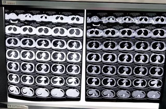 麻醉新术!河南省胸科医院实施非气管插管保留