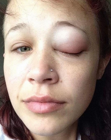 噩梦!加拿大女模做眼球纹身致永久性损伤