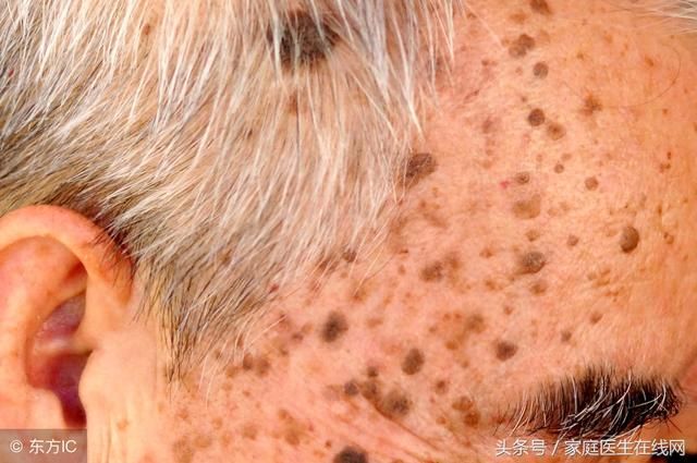 涂抹牙膏或生姜能去老年斑?皮肤科医生做出了