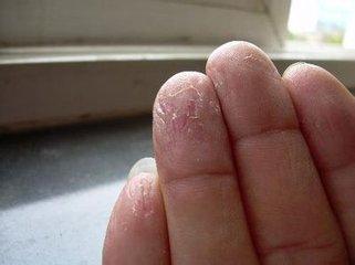 秋冬季干性湿疹又发作了,路边常见一花,告别瘙