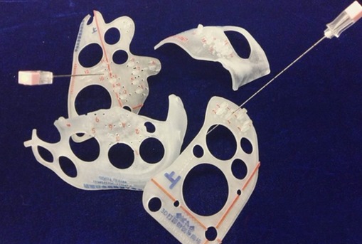 肺部肿瘤3d打印导板,通过长针准确植入放射性粒子