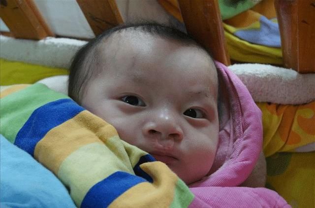 胎儿兔唇是由什么原因引起的?孕期应注意什么