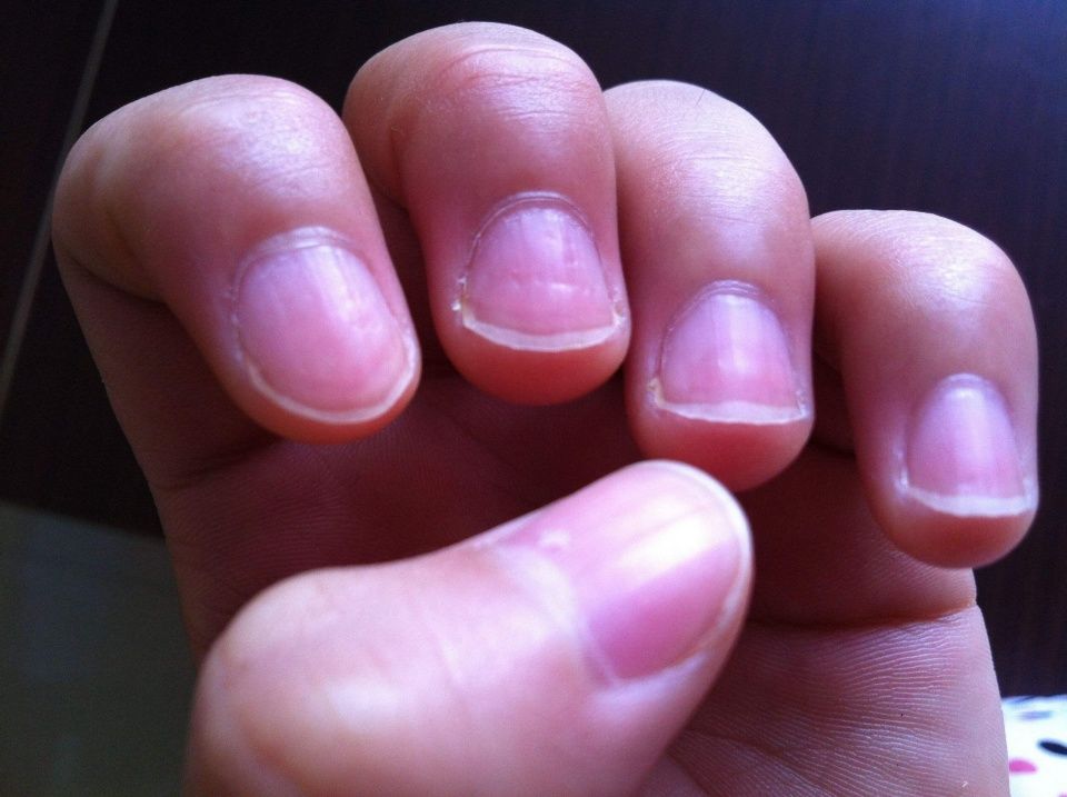 指甲反映的健康隐患,出现这9种指甲或是疾病征