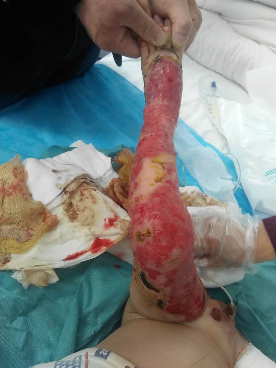 陕西镇安两岁男童跌入煮烫的锅中重度烫伤 恳求爱心人士关注