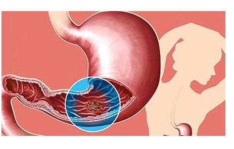 常见的消化性溃疡的发病是由幽门螺杆菌感染所