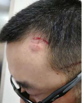 男子劝阻吸烟被打伤 警方:打人者已道歉赔偿