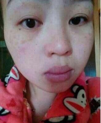 长出老年斑别害怕!药店有一种医用乳膏,用5次